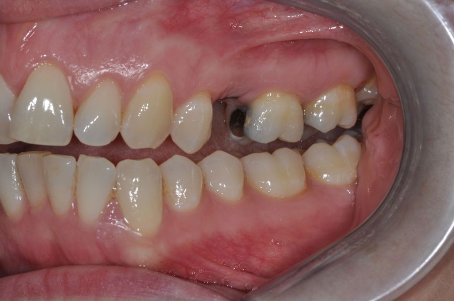 What Material Are Dental Implants Made Of - single tooth implant - before - 3Dental